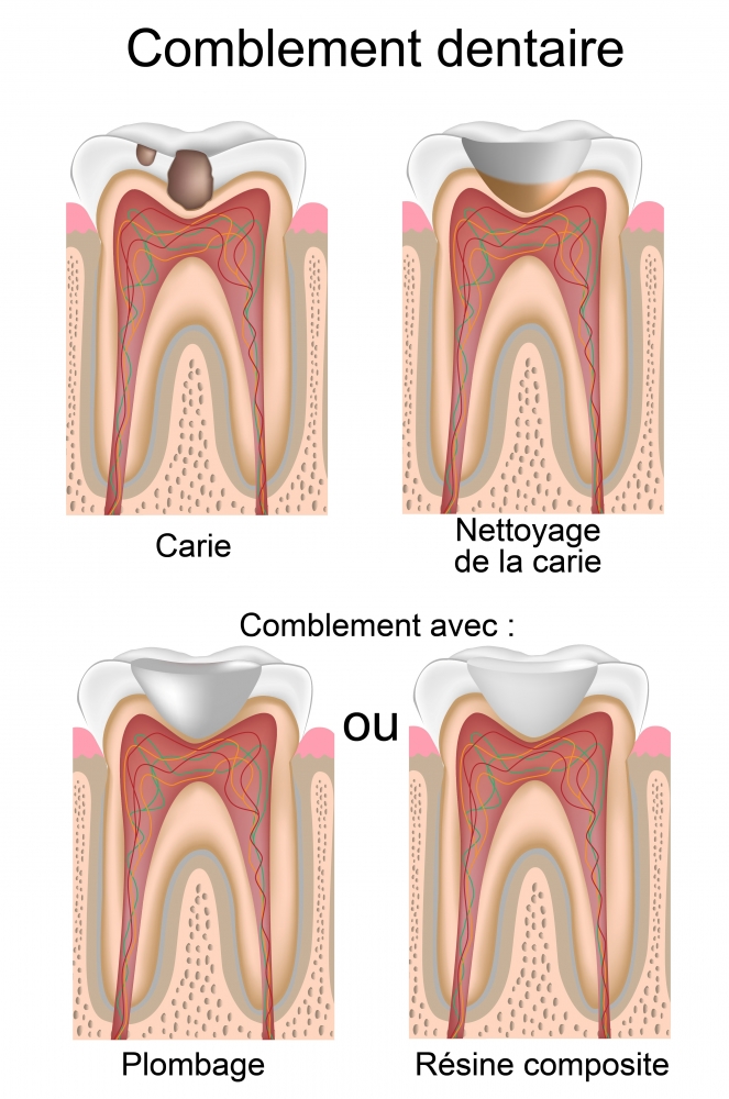 Soigner une carie simple