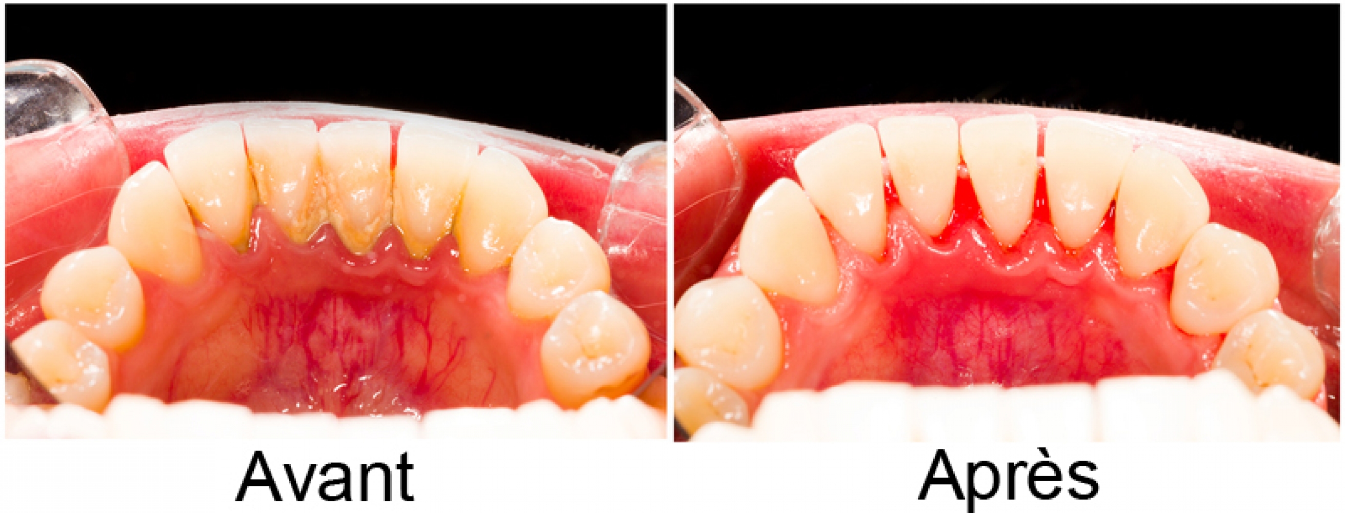 Enlevez le tartre dentaire - Cabinet Dentistes Flach