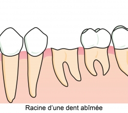 Racines d'une dent abîmée