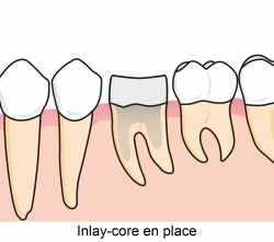 Inlay-core en place