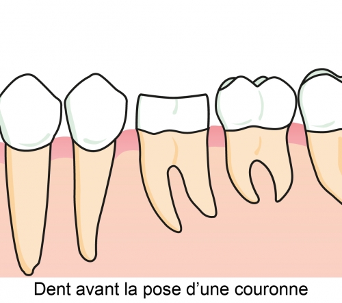 Dent avant la pose d'une couronne