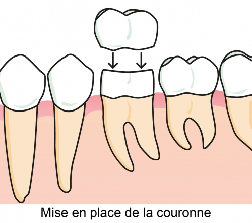 Mise en place de la couronne