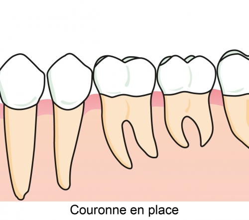 Couronne en place