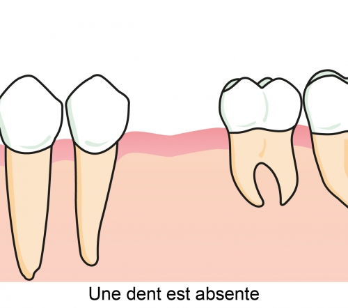 Une dent est absente