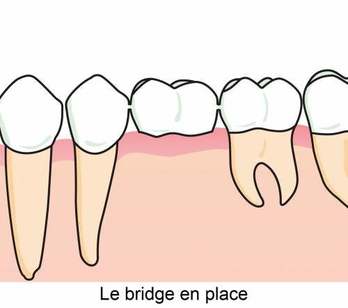 Le bridge en place