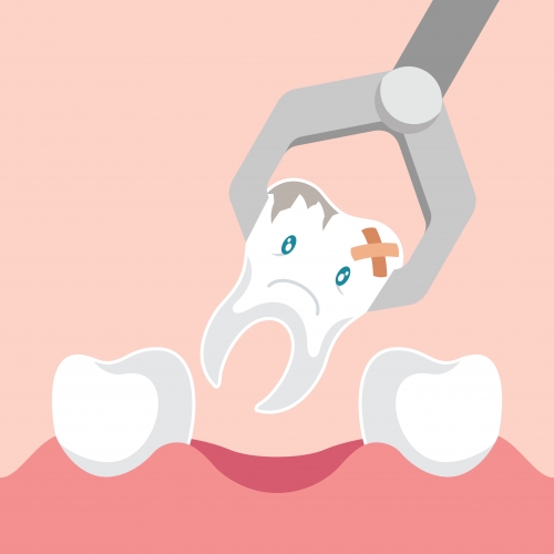 Extraction d'une molaire