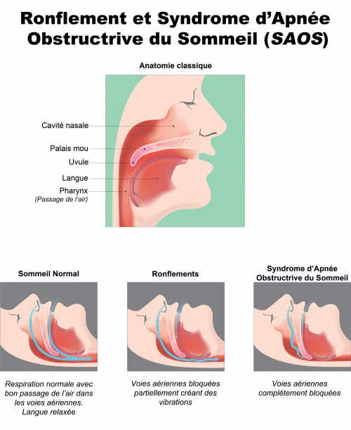 Ronflement et SAOS